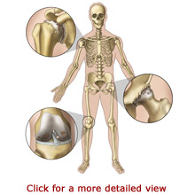 Arthritis