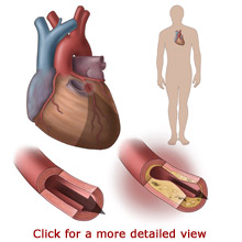 Heart Disease